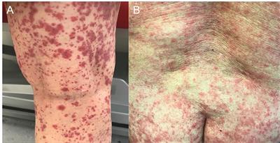 Case Report: Vasculitis Triggered by SIRT in a Patient With Previously Untreated Cholangiocarcinoma